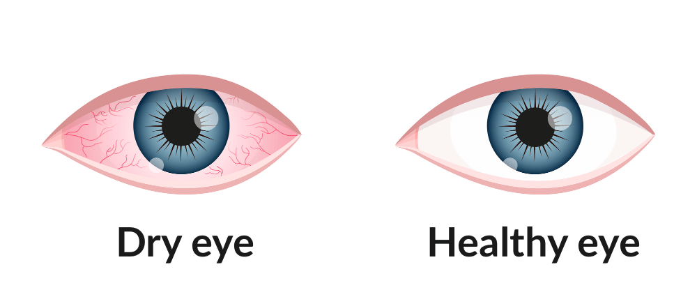 An illustration of a dry eye that's red and irritated-looking beside an illustration of a healthy eye. Both eyes are blue.